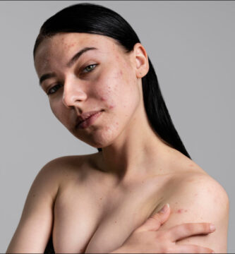 foto en primer plano de una mujer que padece acne hormonal.