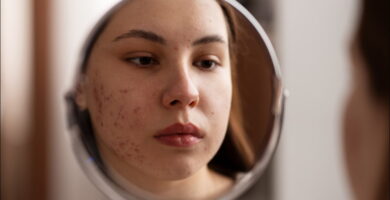 foto de mujer con acné que se mira al espejo