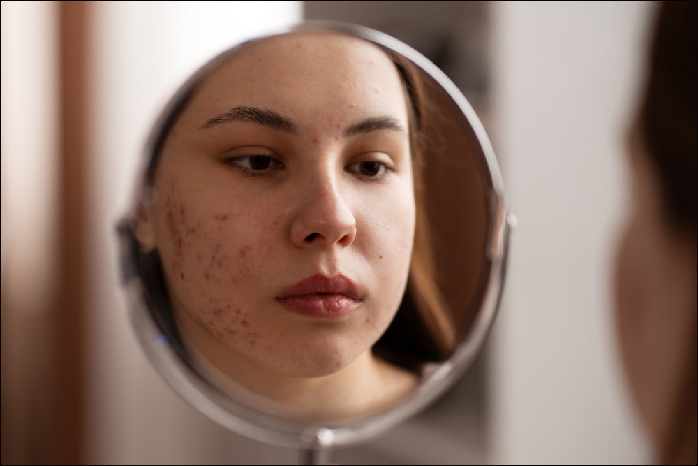 foto de mujer con acné que se mira al espejo